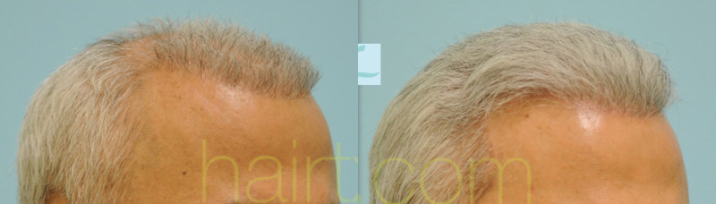 Dallas Crown (Vertex) Hair Restoration Before and After Photos - Plano  Plastic Surgery Photo Gallery - Dr. Samuel Lam23717 | Lam, Sam ()