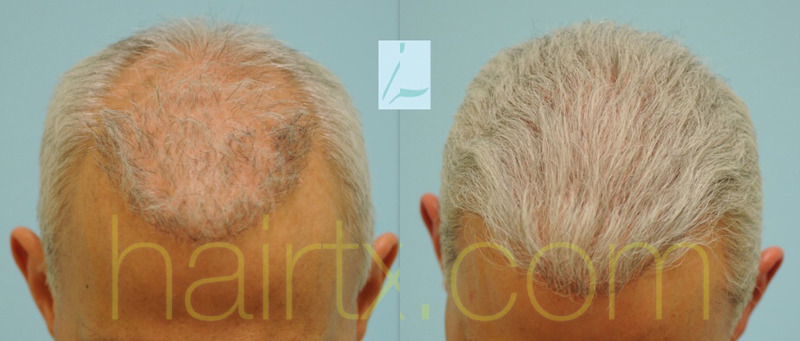 Dallas Hairline and Central Density Hair Restoration Before and After  Photos - Plano Plastic Surgery Photo Gallery - Dr. Samuel LamCorrective Hair  Restoration Archives | Lam, Sam ()