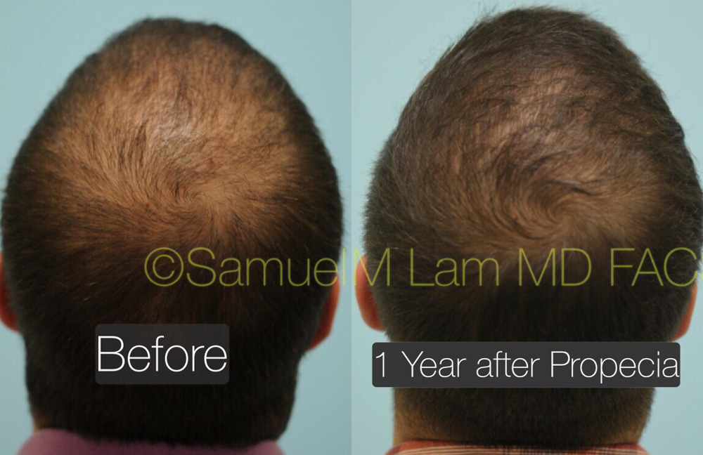 Dallas PRP Injections Before and After Photos - Plano Plastic Surgery Photo  Gallery - Dr. Samuel LamPRP Injections Archives | Lam, Sam ()