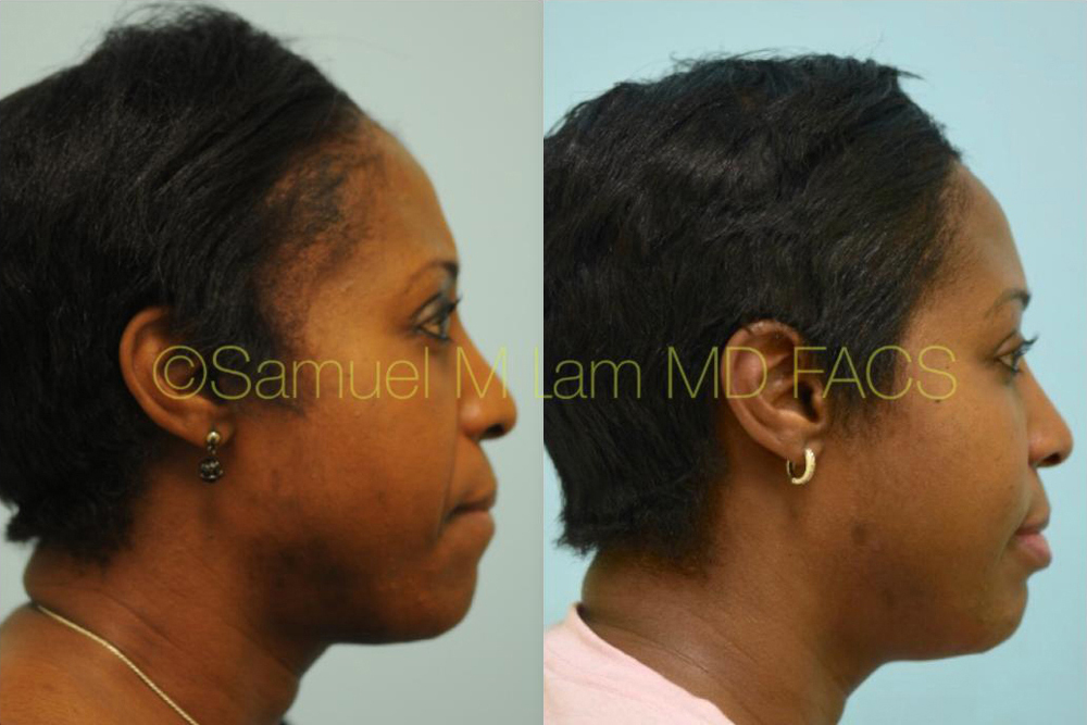 Dallas Eyebrow Hair Restoration Before and After Photos - Plano Plastic  Surgery Photo Gallery - Dr. Samuel LamAfrican Hair Transplant Archives |  Lam, Sam ()