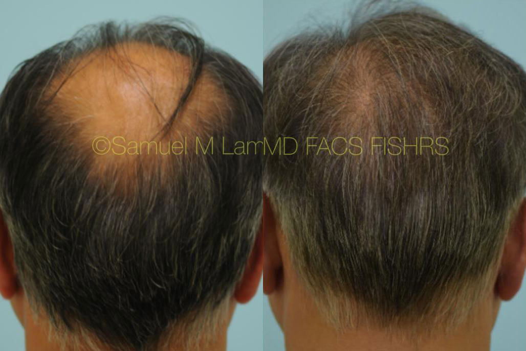 Dallas Hairline and Central Density Hair Restoration Before and After  Photos - Plano Plastic Surgery Photo Gallery - Dr. Samuel LamIndian Hair  Restoration Archives | Lam, Sam ()