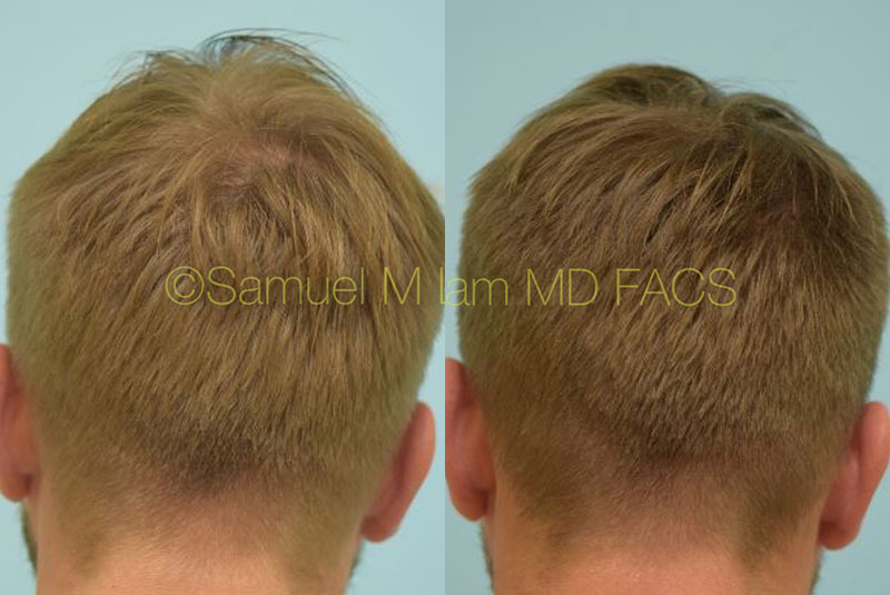 Dallas Finasteride and Minoxidil Before and After Photos - Plano Plastic Surgery Photo Gallery - Dr. Samuel and Minoxidil Archives | Lam, Sam (hairtx.com)