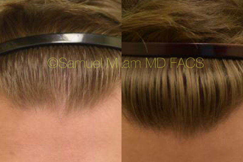 motor massefylde langsom Dallas Finasteride and Minoxidil Before and After Photos - Plano Plastic  Surgery Photo Gallery - Dr. Samuel LamFinasteride and Minoxidil Archives |  Lam, Sam (hairtx.com)