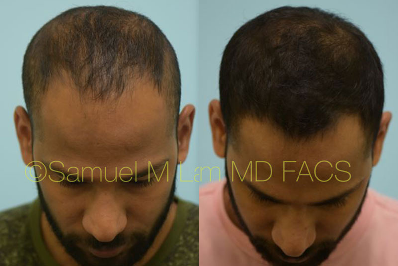 motor massefylde langsom Dallas Finasteride and Minoxidil Before and After Photos - Plano Plastic  Surgery Photo Gallery - Dr. Samuel LamFinasteride and Minoxidil Archives |  Lam, Sam (hairtx.com)