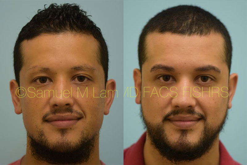 Dallas Eyebrow Hair Restoration Before and After Photos - Plano Plastic  Surgery Photo Gallery - Dr. Samuel Lam29055 | Lam, Sam ()