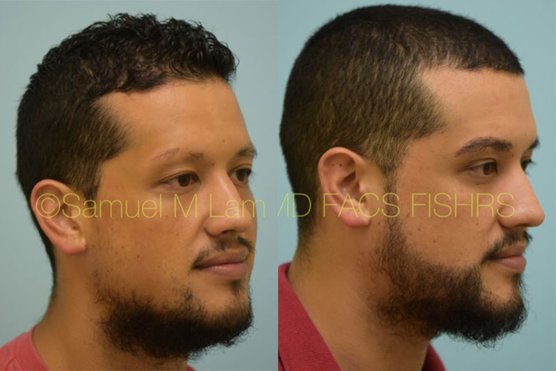 Dallas Hispanic Hair Transplant Before and After Photos - Plano Plastic  Surgery Photo Gallery - Dr. Samuel LamHispanic Hair Transplant Archives |  Lam, Sam (hairtx.com)