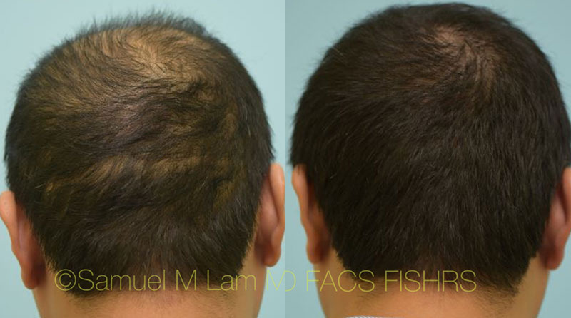 Minoxidil finasterid oder Finasteride and