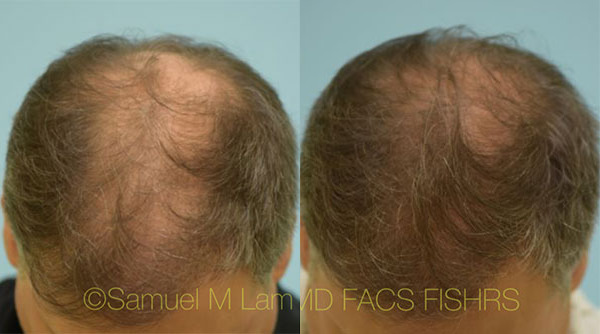 motor massefylde langsom Dallas Finasteride and Minoxidil Before and After Photos - Plano Plastic  Surgery Photo Gallery - Dr. Samuel LamFinasteride and Minoxidil Archives |  Lam, Sam (hairtx.com)