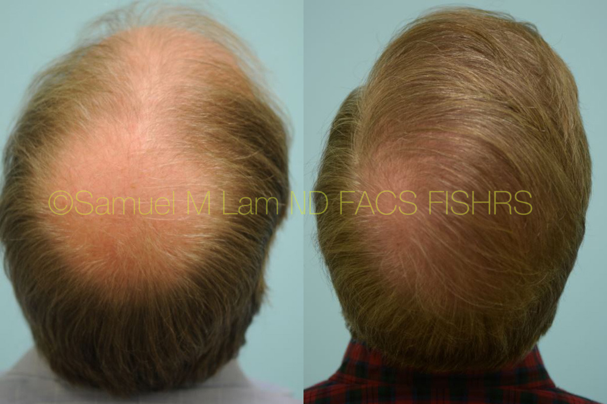 Dallas Crown (Vertex) Hair Restoration Before and After Photos - Plano  Plastic Surgery Photo Gallery - Dr. Samuel LamCrown (Vertex) Hair  Restoration Archives | Lam, Sam ()