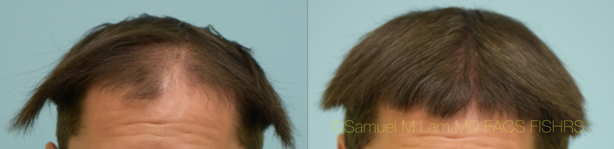 Dallas Finasteride and Minoxidil Before and After Photos - Plano Plastic Surgery Photo Gallery - Dr. Samuel and Minoxidil Archives | Lam, Sam (hairtx.com)