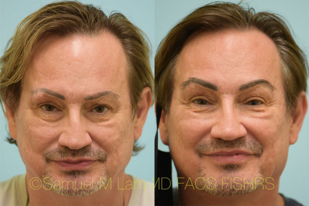 Dallas Eyebrow Hair Restoration Before and After Photos - Plano Plastic  Surgery Photo Gallery - Dr. Samuel LamEyebrow Hair Transplant Archives |  Lam, Sam ()