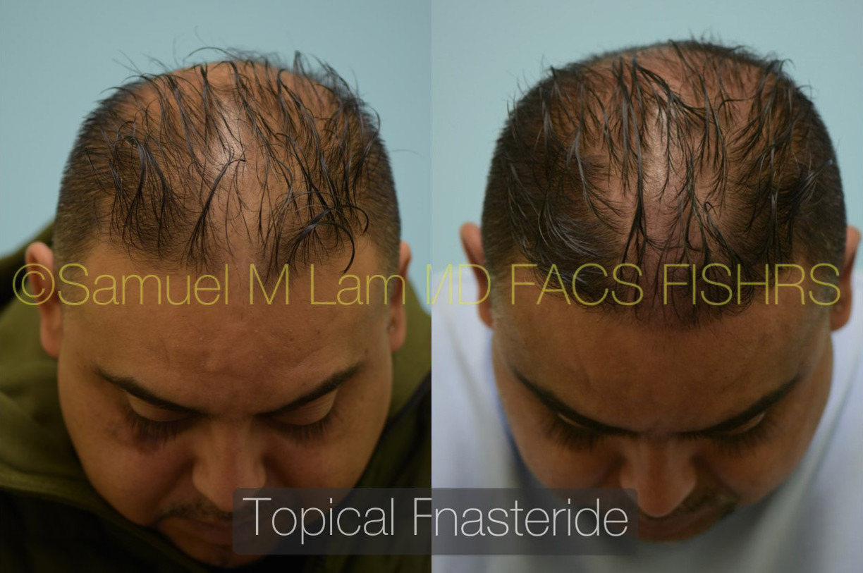 Minoxidil finasterid The Efficacy