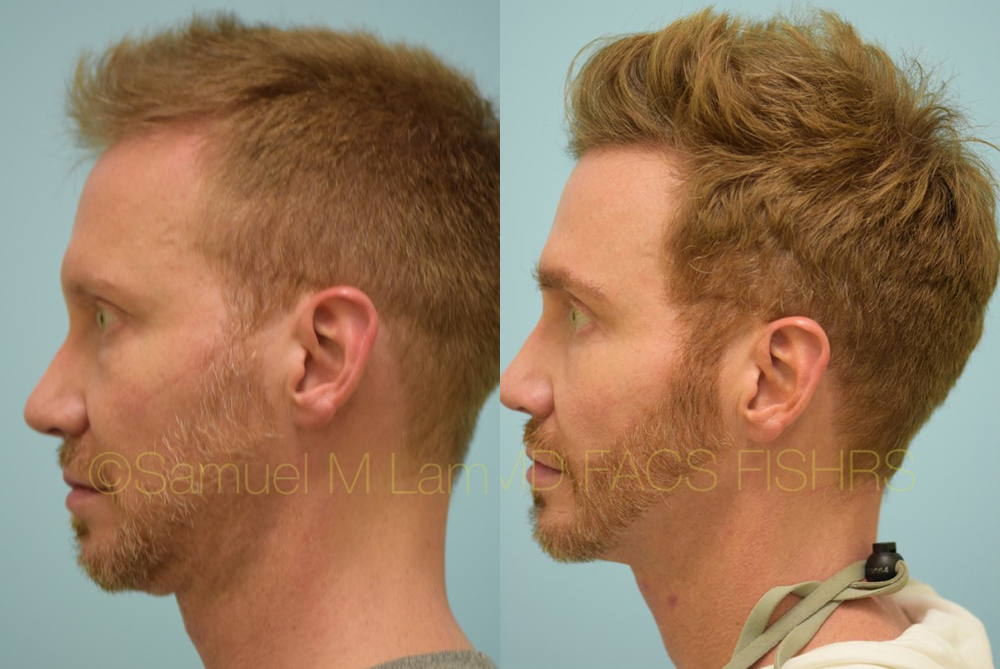 Dallas Crown (Vertex) Hair Restoration Before and After Photos - Plano  Plastic Surgery Photo Gallery - Dr. Samuel LamFUE Archives | Lam, Sam  ()