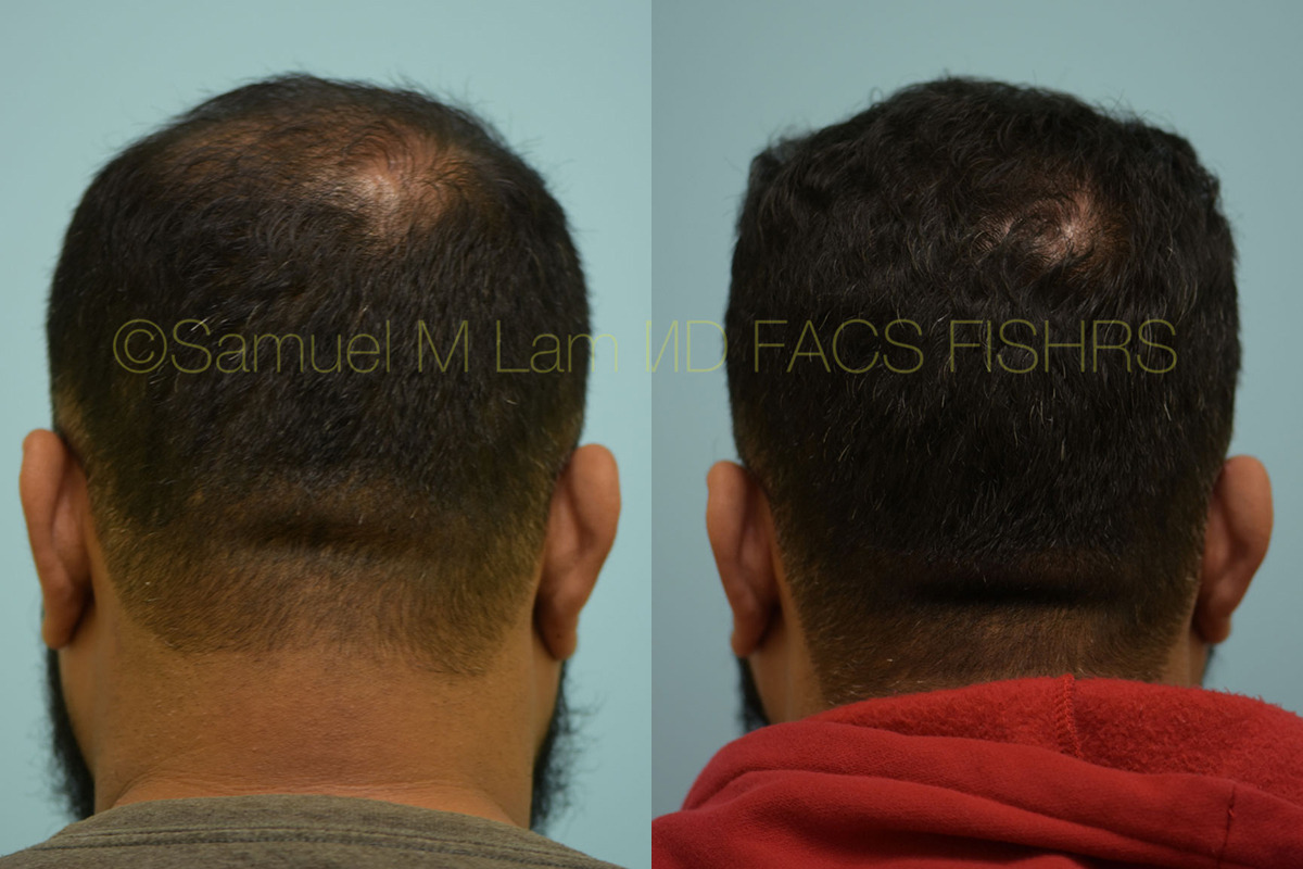 Dallas Finasteride and Minoxidil Before and After Photos - Plano Plastic  Surgery Photo Gallery - Dr. Samuel LamFinasteride and Minoxidil Archives |  Lam, Sam ()