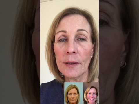 Mary's Eyebrow Hair Transplant Testimonial & Photos