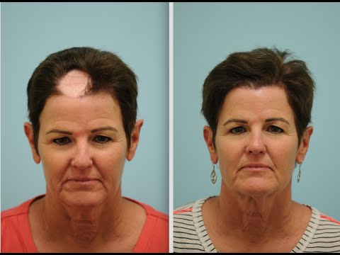 Hair Transplant Testimonial for Scar Repair/Cancer Reconstruction