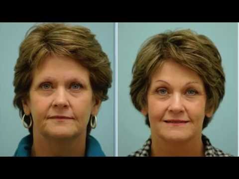 6 Month Revision/Corrective Eyebrow Hair Transplant  Recovery Journal & Testimonial