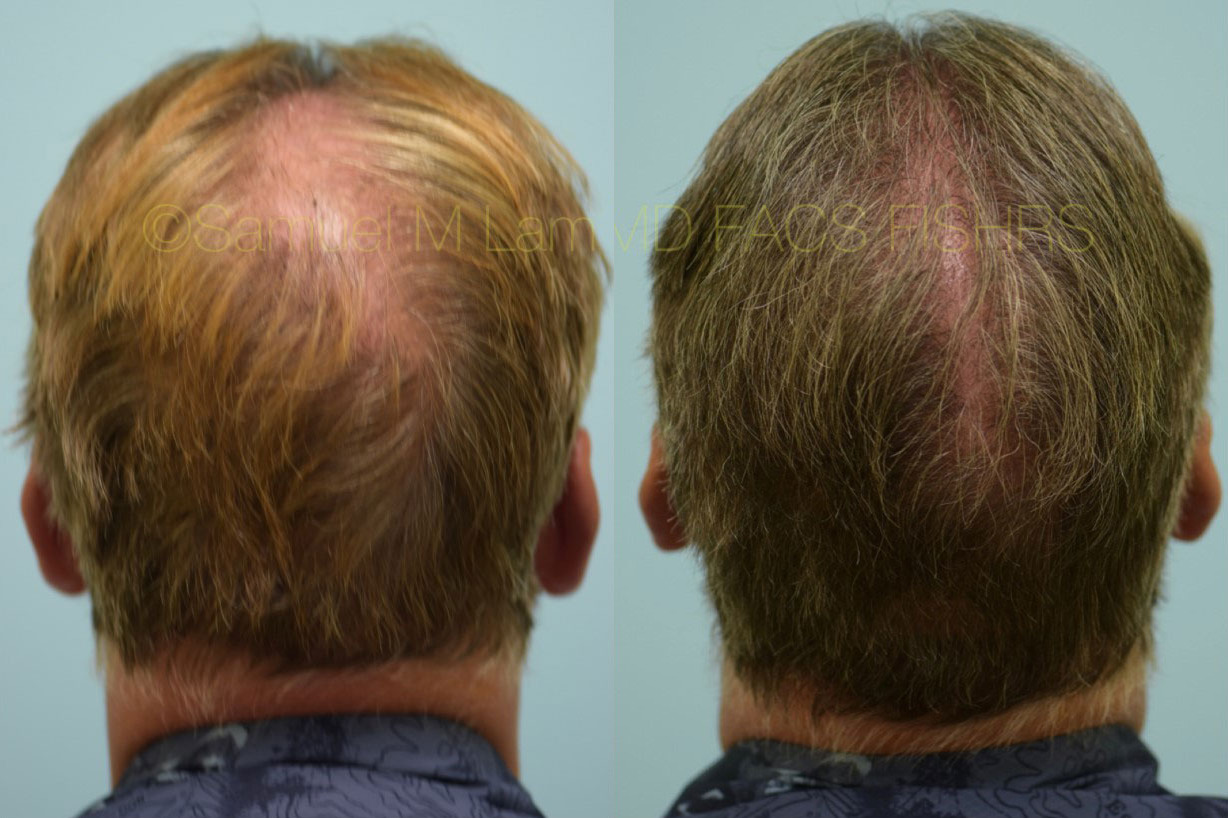 Dallas Crown (Vertex) Hair Restoration Before and After Photos - Plano  Plastic Surgery Photo Gallery - Dr. Samuel LamCrown (Vertex) Hair  Restoration Archives | Lam, Sam ()