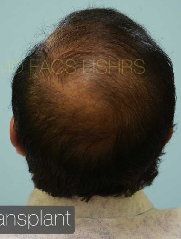 Hairline and Central Density Hair Restoration