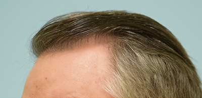 Hairline and Central Density Hair Restoration