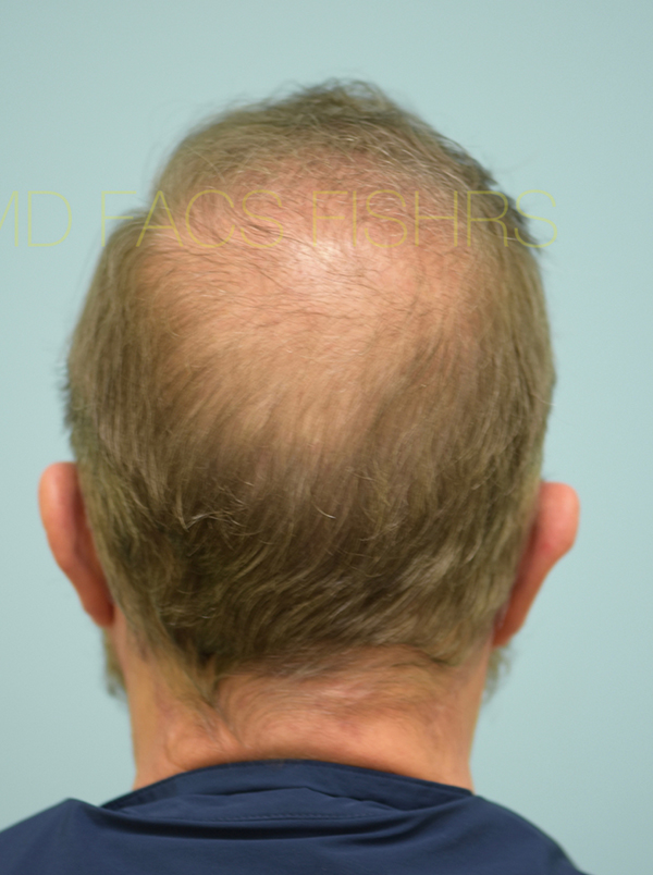 Hairline and Central Density Hair Restoration