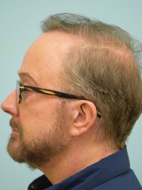 Hairline and Central Density Hair Restoration