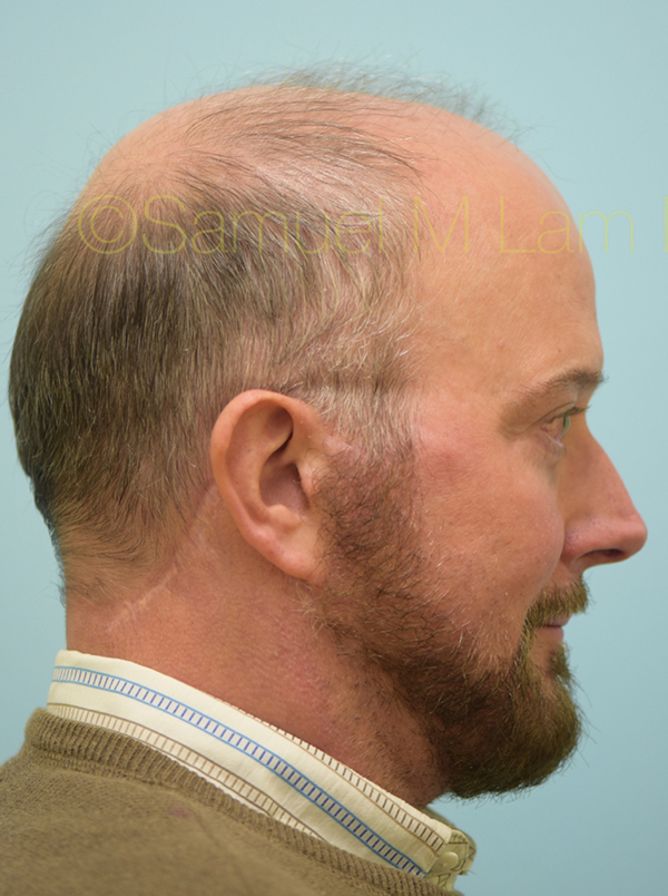 Hairline and Central Density Hair Restoration