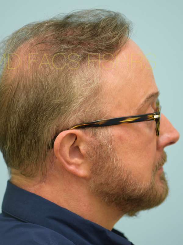 Hairline and Central Density Hair Restoration