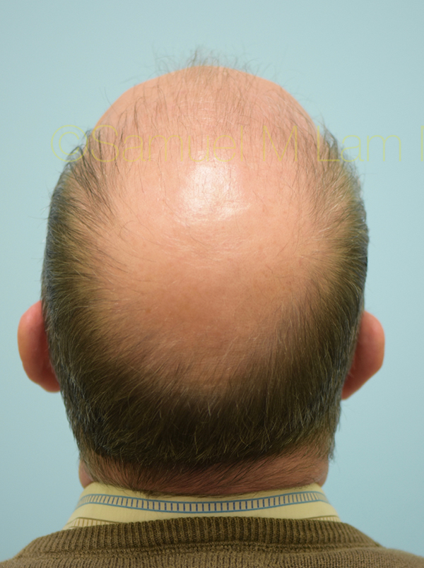 Hairline and Central Density Hair Restoration