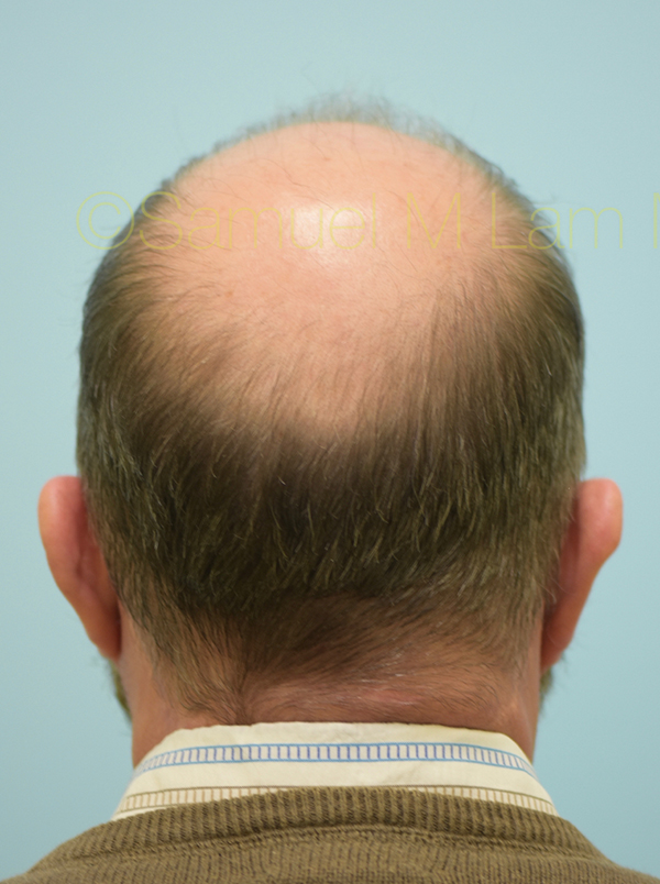 Hairline and Central Density Hair Restoration