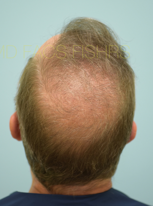 Hairline and Central Density Hair Restoration