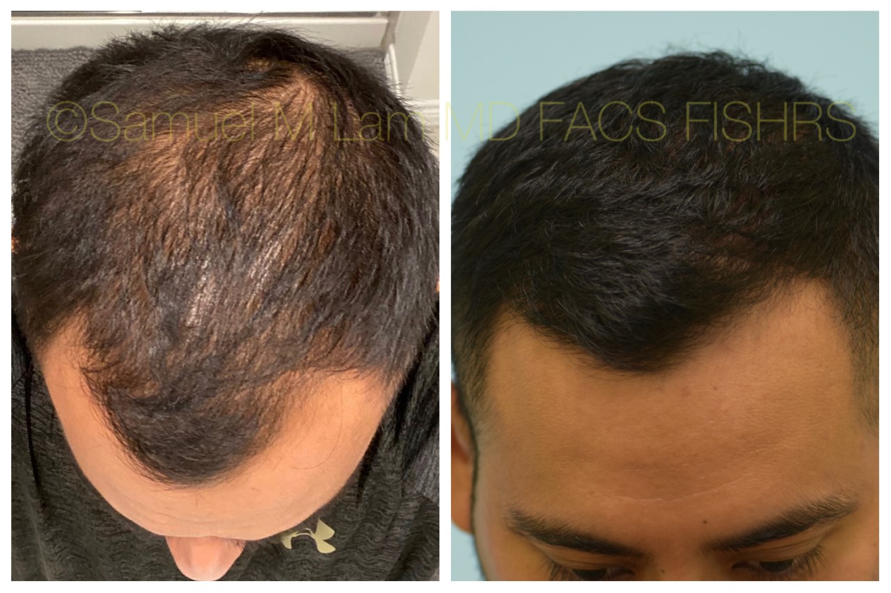 motor massefylde langsom Dallas Finasteride and Minoxidil Before and After Photos - Plano Plastic  Surgery Photo Gallery - Dr. Samuel LamFinasteride and Minoxidil Archives |  Lam, Sam (hairtx.com)