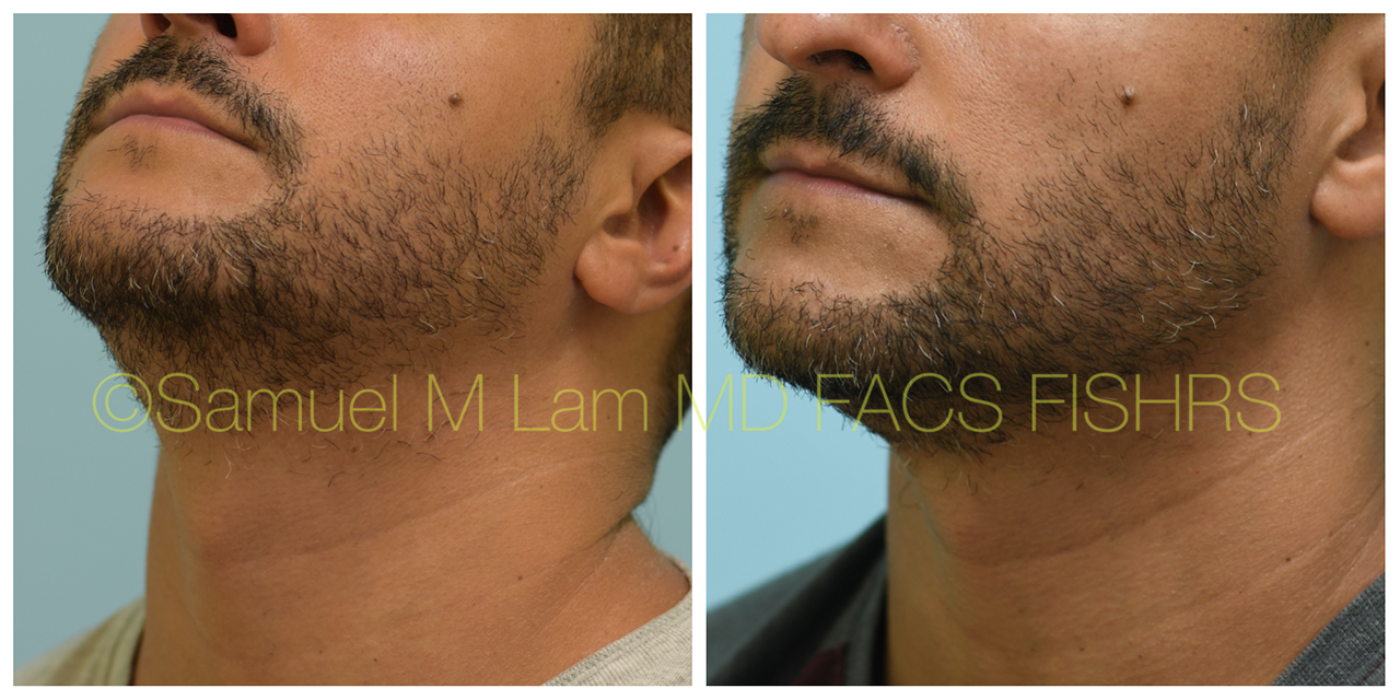 Dallas Crown (Vertex) Hair Restoration Before and After Photos - Plano  Plastic Surgery Photo Gallery - Dr. Samuel LamFUE Archives | Lam, Sam  ()