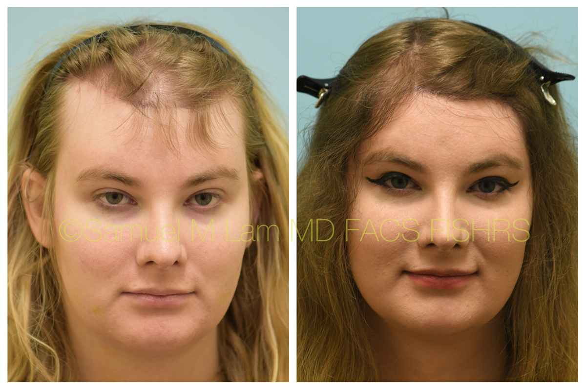 Dallas Female Hair Restoration Before and After Photos - Plano Plastic  Surgery Photo Gallery - Dr. Samuel LamFemale Hairline Lowering Archives |  Lam, Sam ()