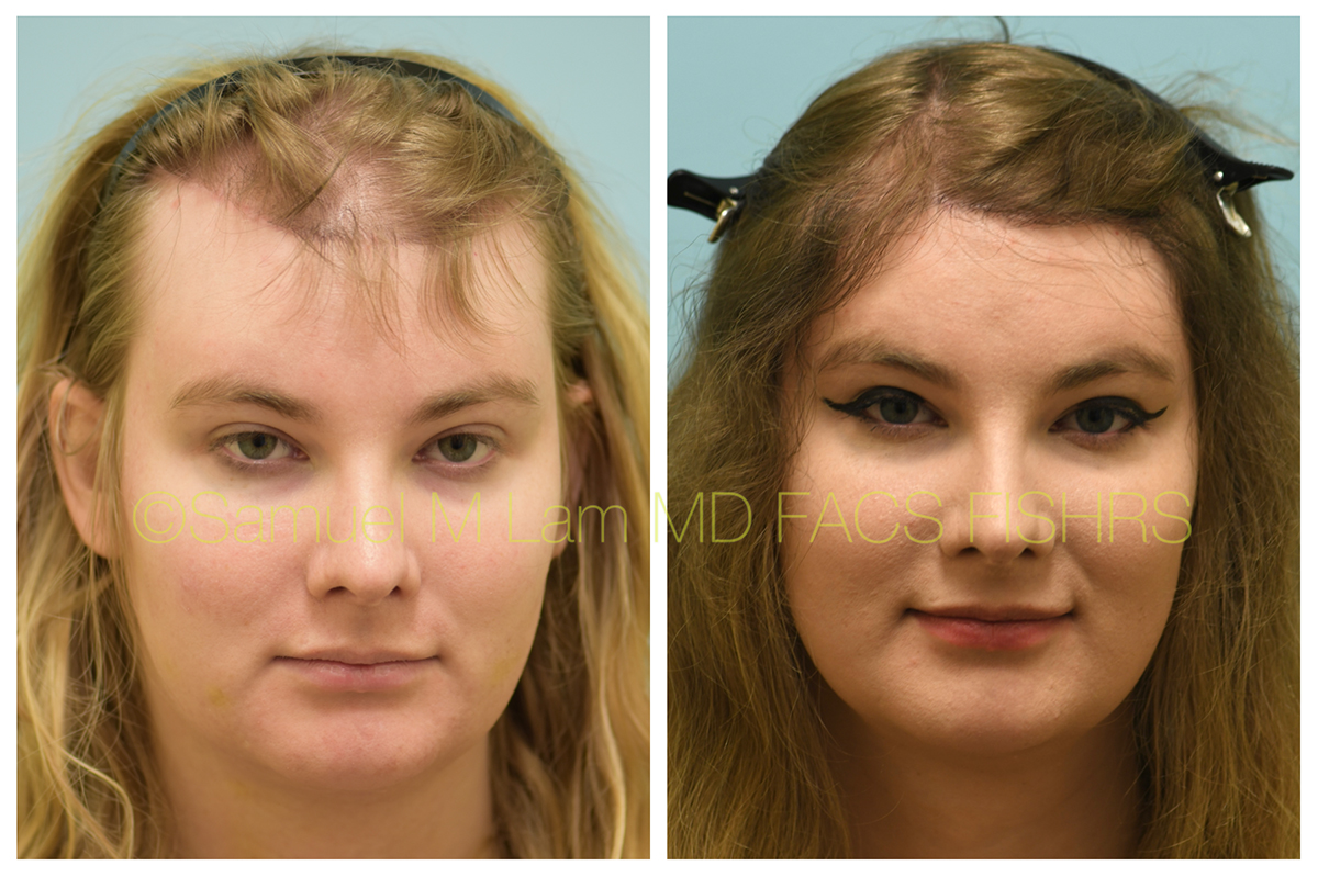 Dallas Female Hair Restoration Before and After Photos - Plano Plastic Surgery Photo Gallery - Dr. Samuel LamFemale Hair Restoration Archives | Lam, Sam () Dallas Female Hair Restoration Before and After Photos - Plano Plastic Surgery Photo Gallery - Dr. Samuel LamFemale Hair Restoration Archives | Lam, Sam ()
