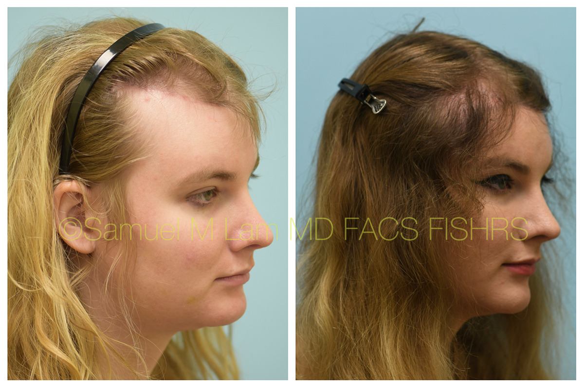 Dallas Female Hair Restoration Before and After Photos - Plano Plastic Surgery Photo Gallery - Dr. Samuel LamFemale Hair Restoration Archives | Lam, Sam () Dallas Female Hair Restoration Before and After Photos - Plano Plastic Surgery Photo Gallery - Dr. Samuel LamFemale Hair Restoration Archives | Lam, Sam ()