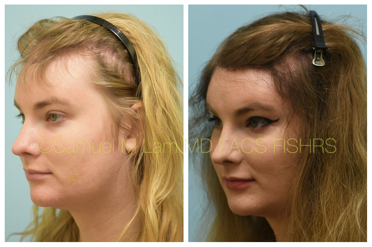 Dallas Female Hair Restoration Before and After Photos - Plano Plastic  Surgery Photo Gallery - Dr. Samuel LamFemale Hair Restoration Archives |  Lam, Sam ()