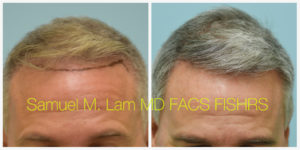 Male Hair Restoration Results