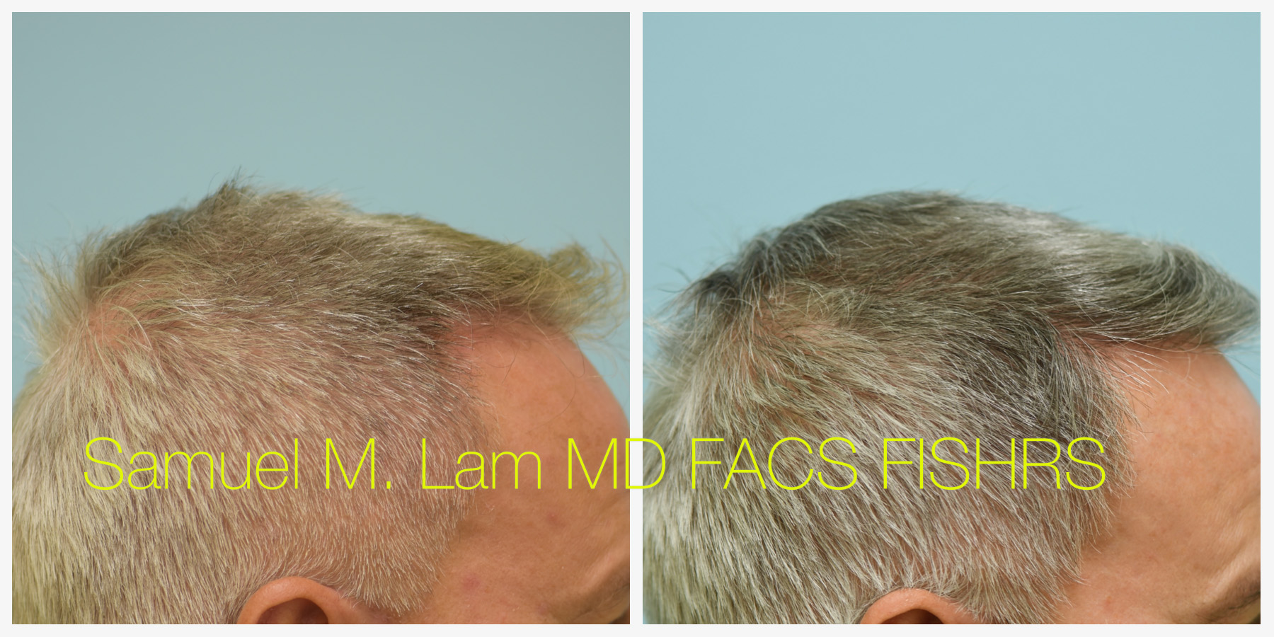 Dallas Hairline and Central Density Hair Restoration Before and After  Photos - Plano Plastic Surgery Photo Gallery - Dr. Samuel LamHairline and  Central Density Hair Restoration Archives | Lam, Sam ()