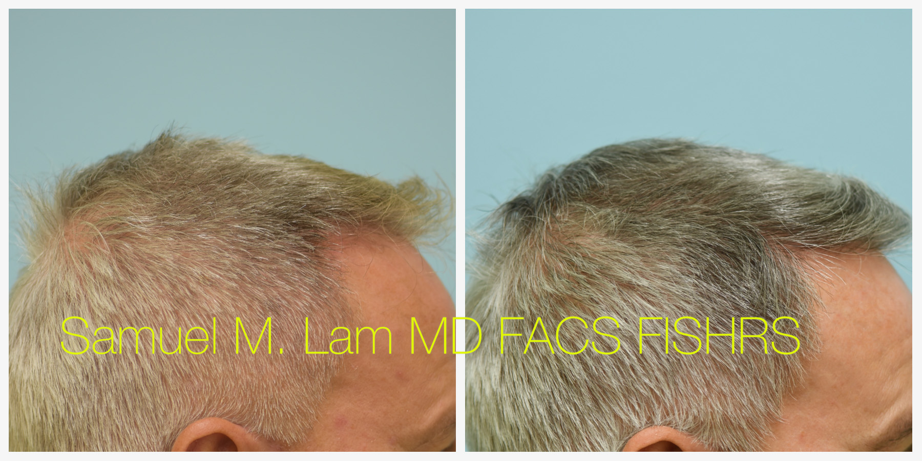 Male Hair Restoration Results