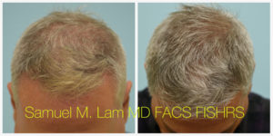 Male Hair Restoration Results
