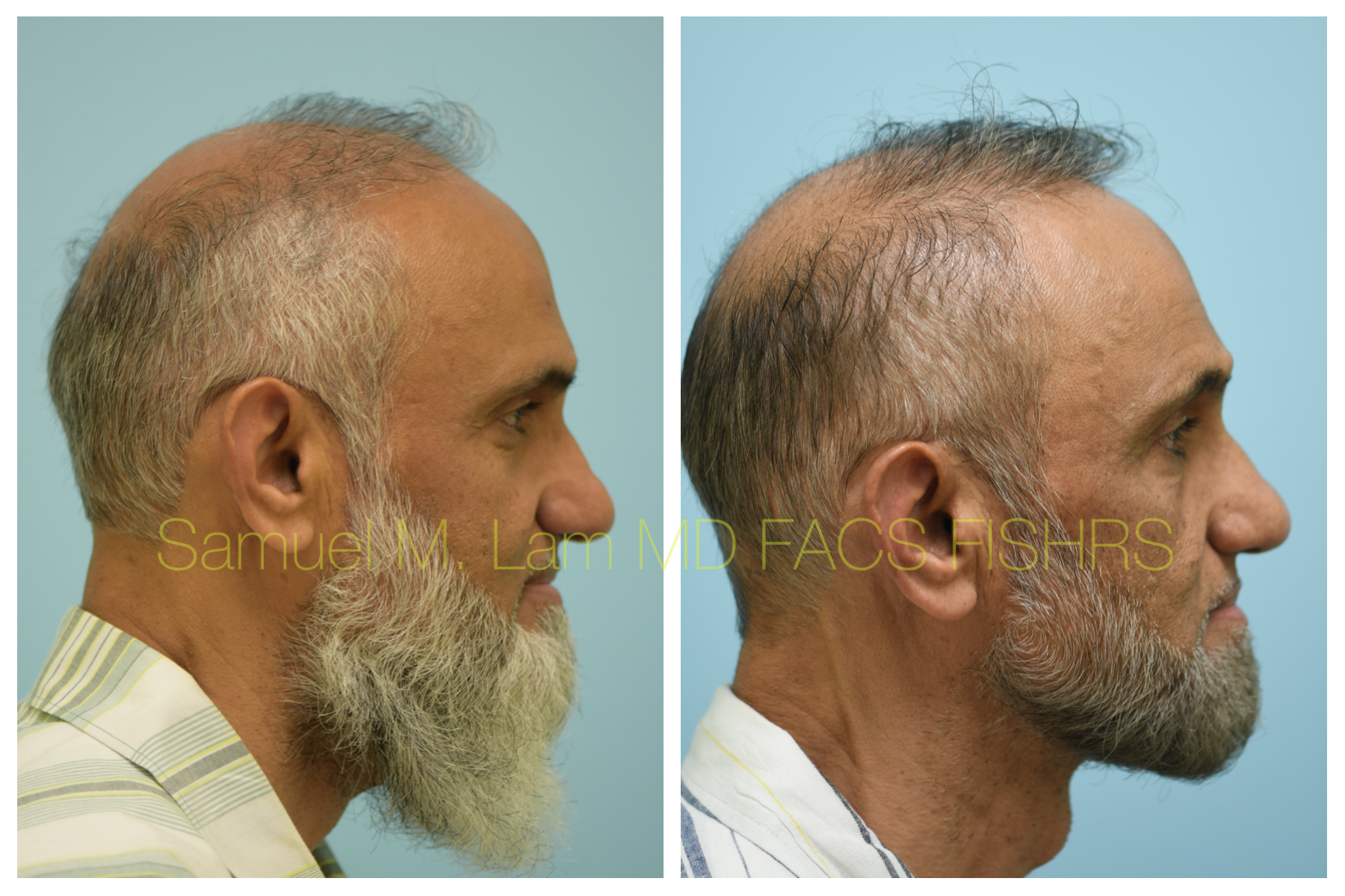 4 Reasons that decides Hair Transplant Success Rate - RepHair