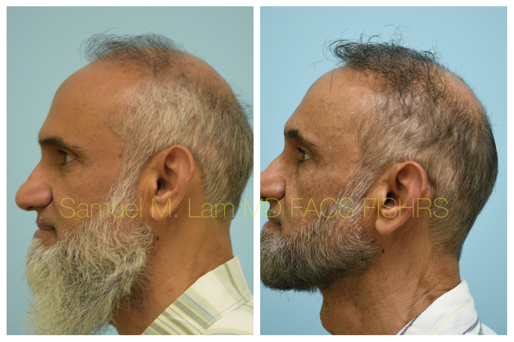 FUE Transplant Before & After