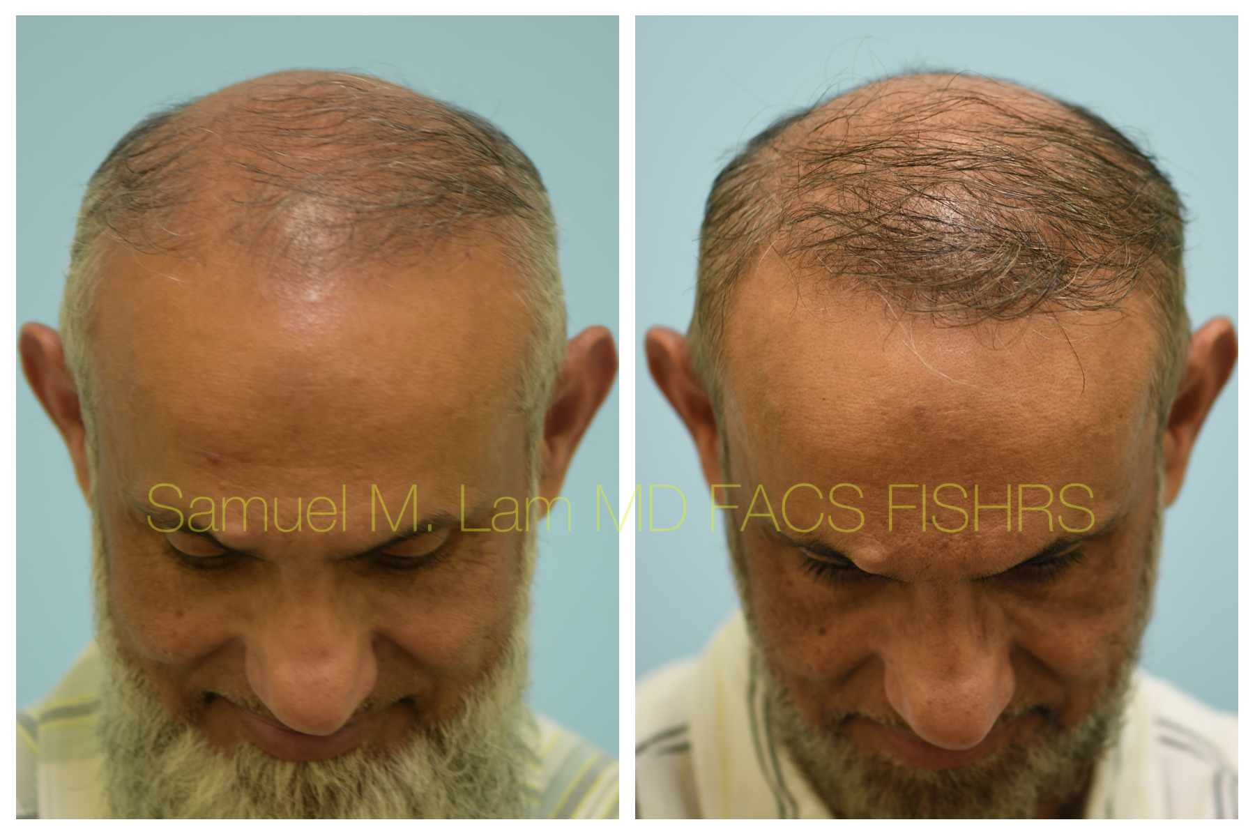 FUE Transplant Before & After