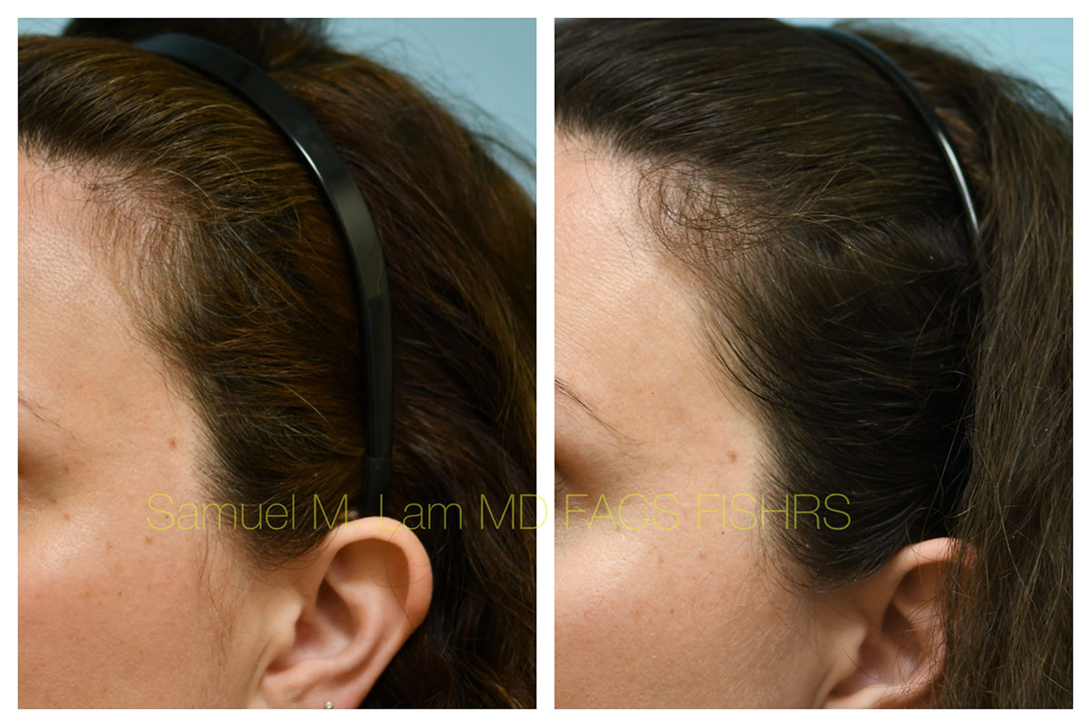 PRP/Hair Stem Before and After Photo by Dr. Lam in Plano, TX