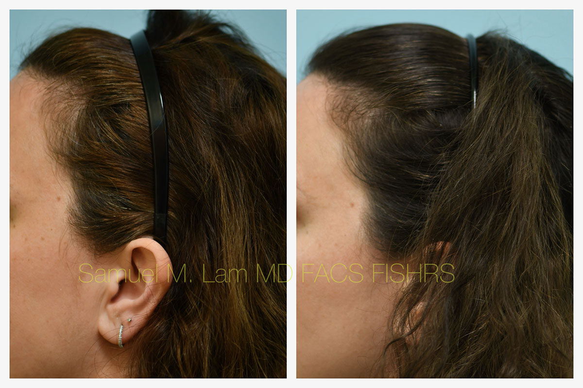 PRP/Hair Stem Before and After Photo by Dr. Lam in Plano, TX