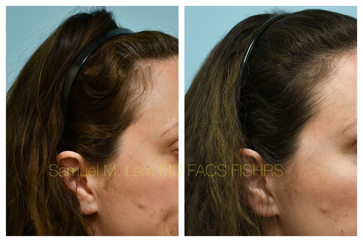 PRP/Hair Stem Before and After Photo by Dr. Lam in Plano, TX