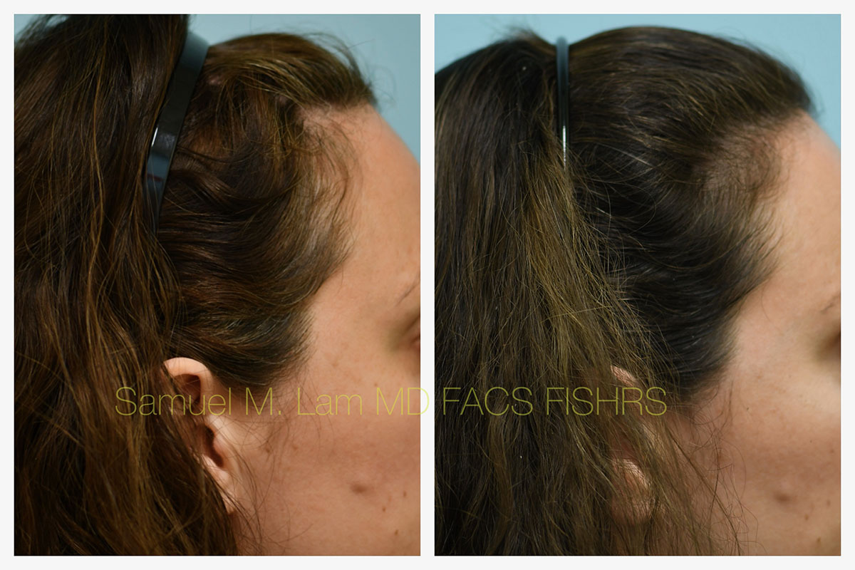 PRP/Hair Stem Before and After Photo by Dr. Lam in Plano, TX