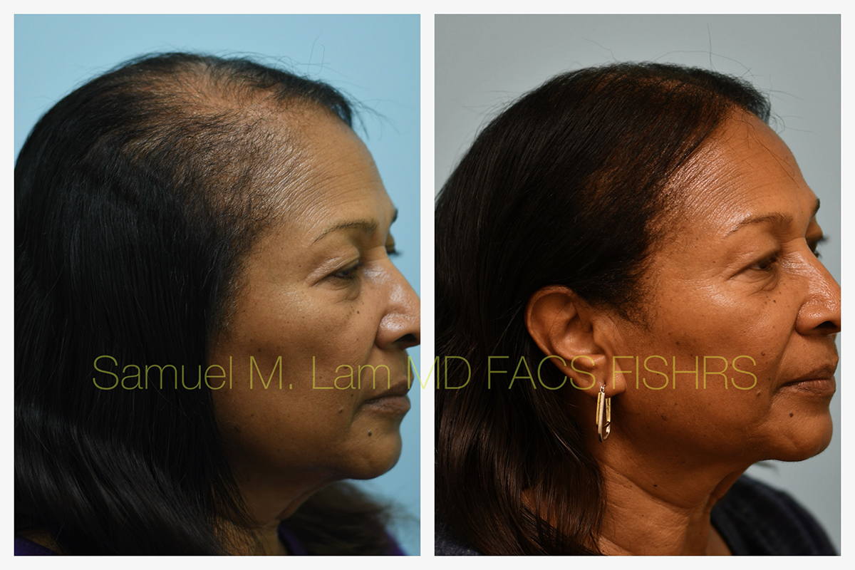 African American Hair Transplant Before and After Photo by Dr. Lam in Plano, TX