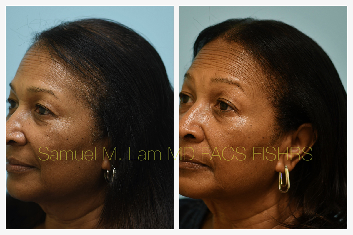 African American Hair Transplant Before and After Photo by Dr. Lam in Plano, TX